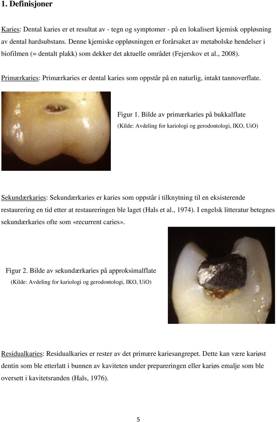 Primærkaries: Primærkaries er dental karies som oppstår på en naturlig, intakt tannoverflate. Figur 1.