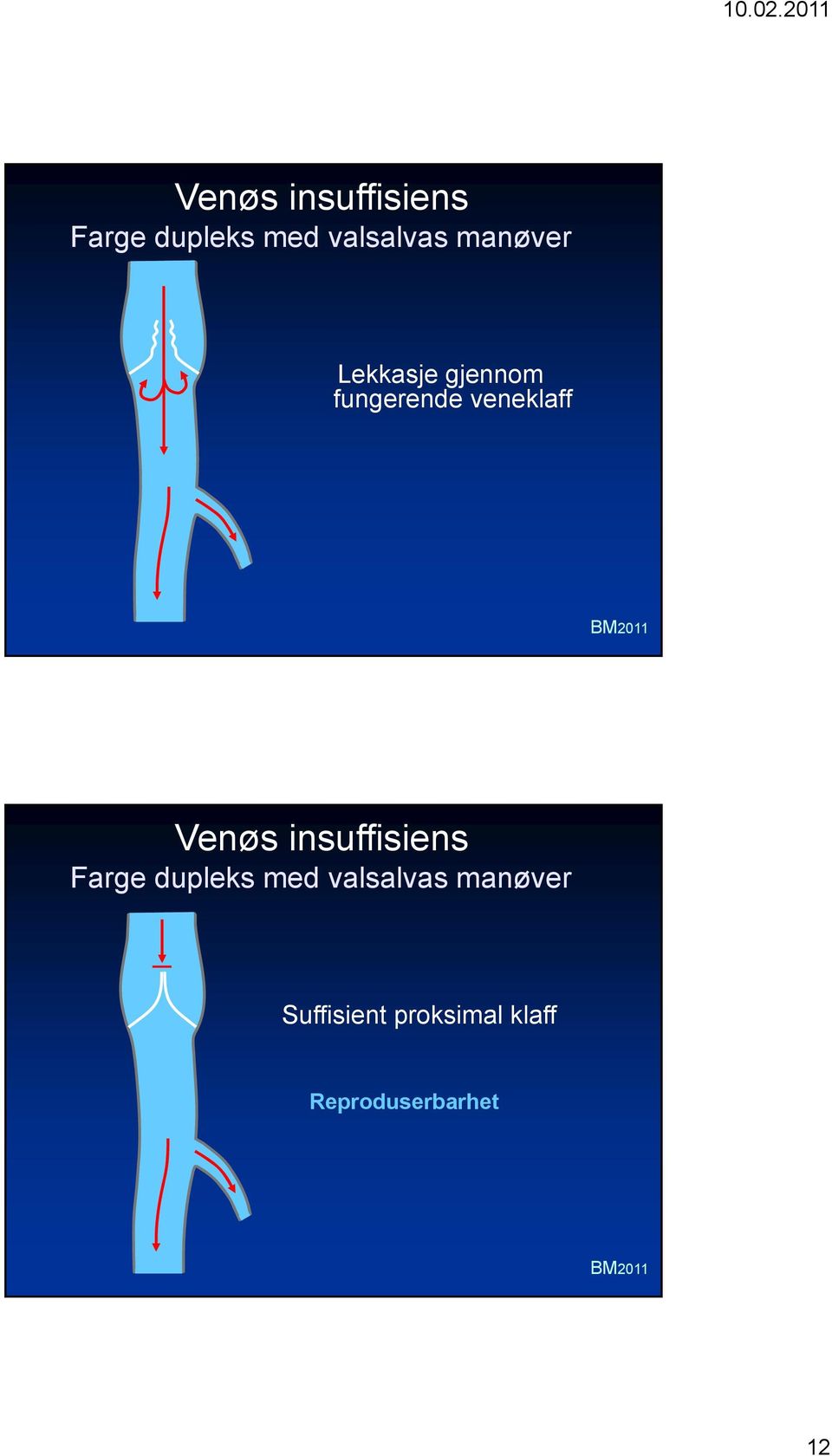 med valsalvas manøver