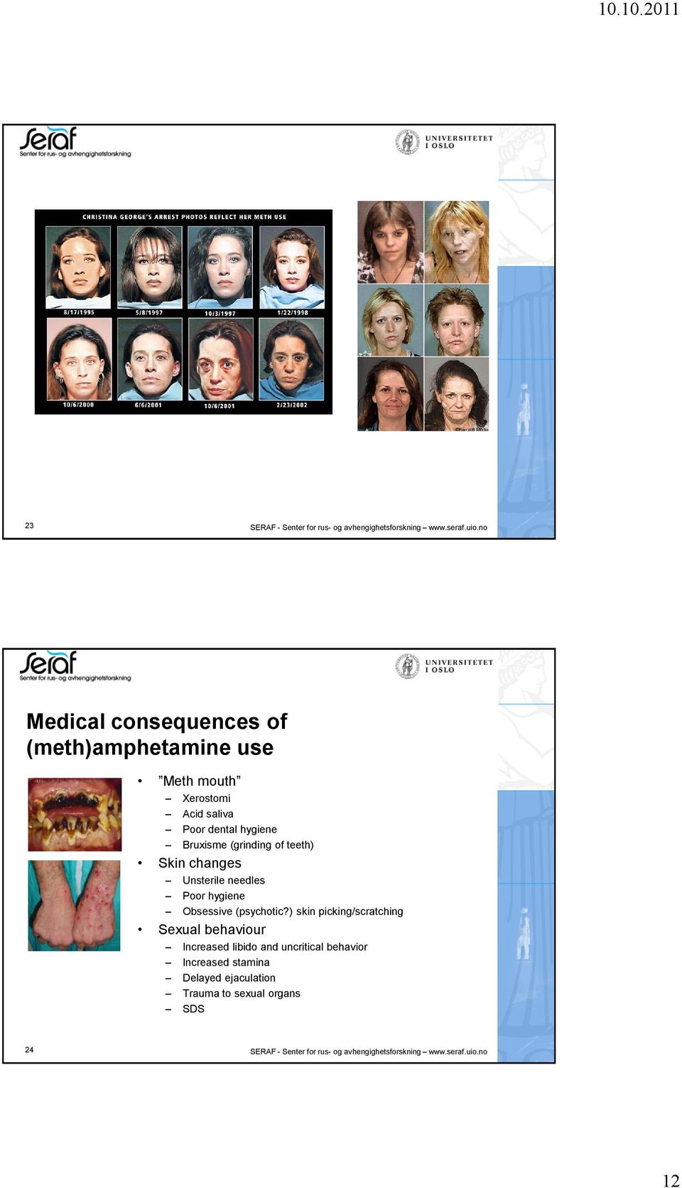 of teeth) Skin changes Unsterile needles Poor hygiene Obsessive (psychotic?