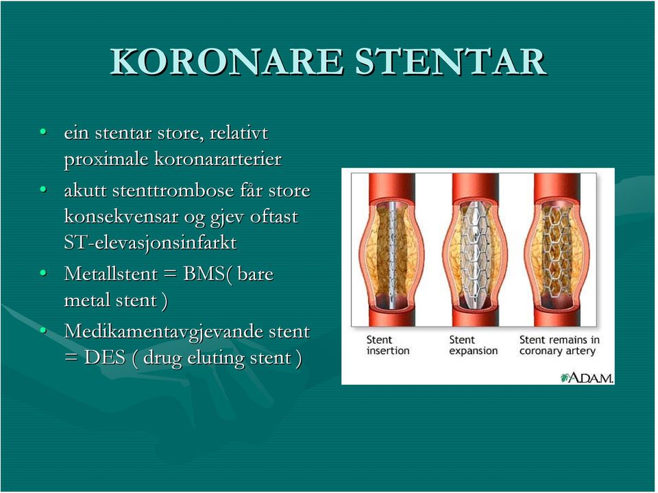 og gjev oftast ST-elevasjonsinfarkt Metallstent = BMS( bare