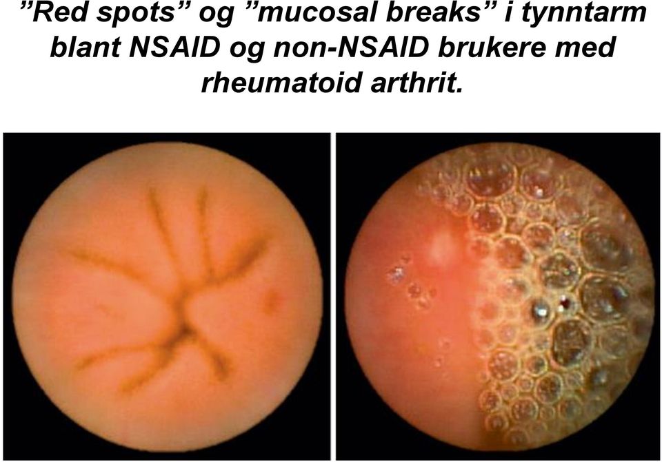 NSAID og non-nsaid