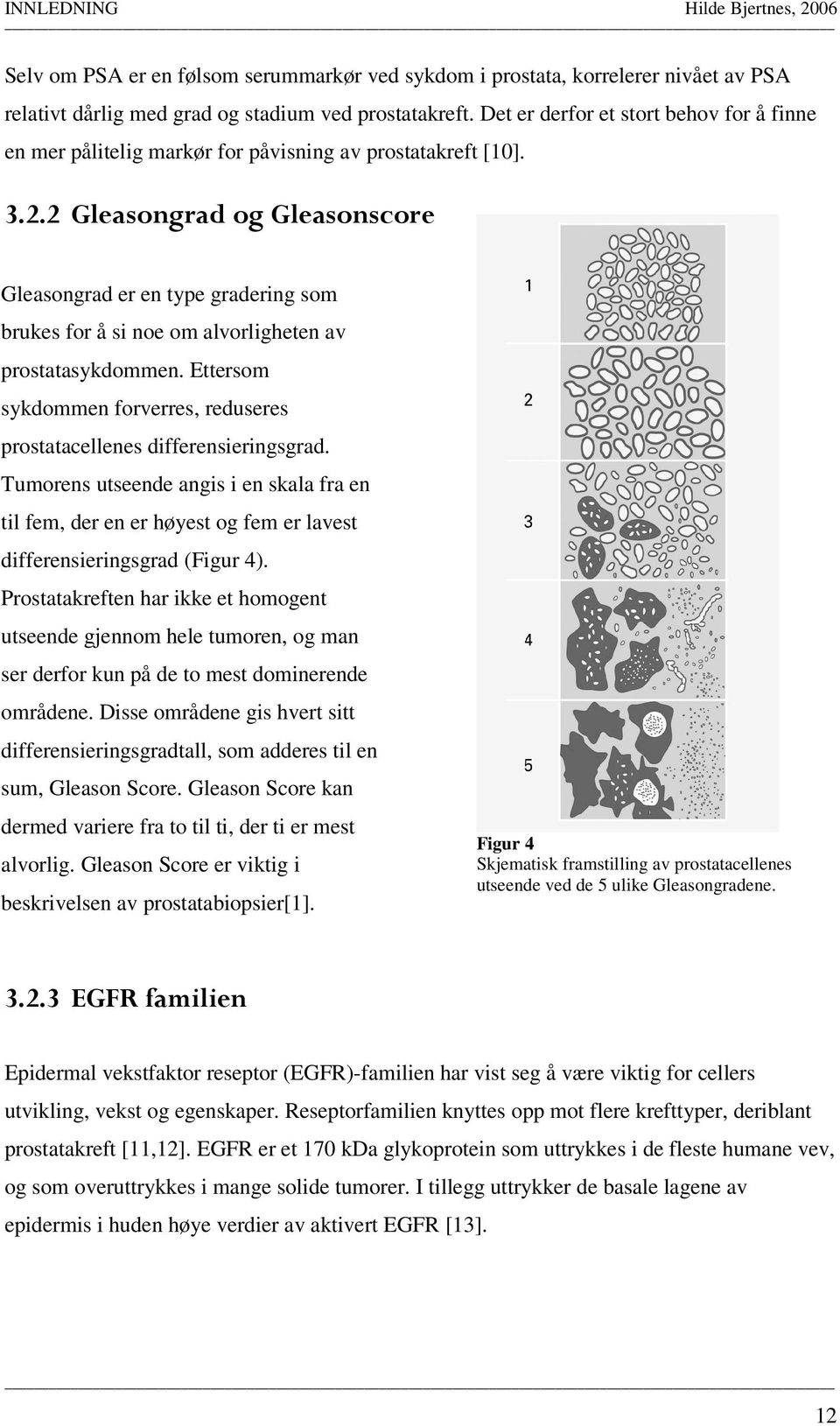 2 Gleasongrad og Gleasonscore Gleasongrad er en type gradering som brukes for å si noe om alvorligheten av prostatasykdommen.