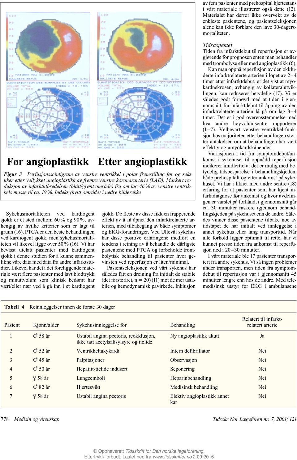 Figur 3 Perfusjonsscintigram av venstre ventrikkel i polar fremstilling før og seks uker etter vellykket angioplastikk av fremre venstre koronararterie (LAD).