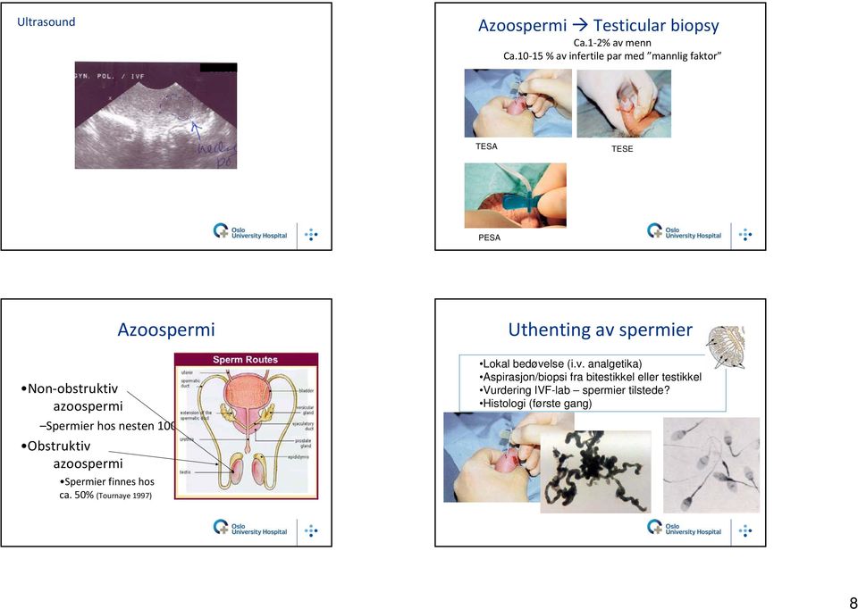 Spermier hos nesten 100% Obstruktiv azoospermi Spermier finnes hos ca.