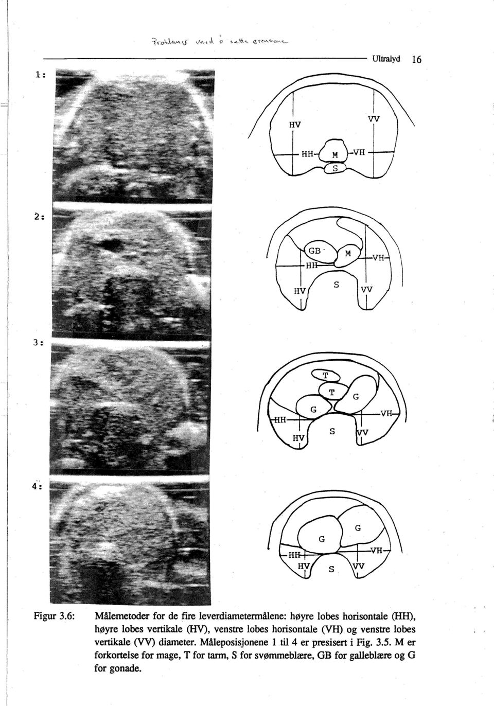 (HV), venstre lobes horisontale (VH) og venstre lobes vertikale (VV) diameter.