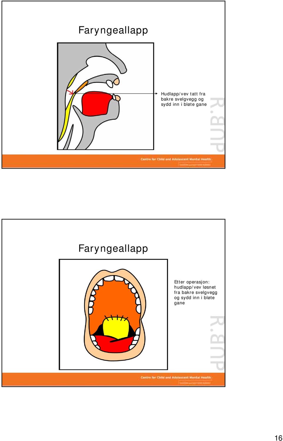 Faryngeallapp Etter operasjon: hudlapp/vev