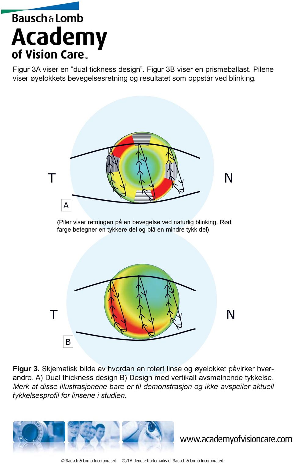 T N A (Piler viser retningen på en bevegelse ved naturlig blinking.