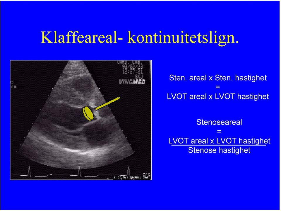 hastighet = LVOT areal x LVOT