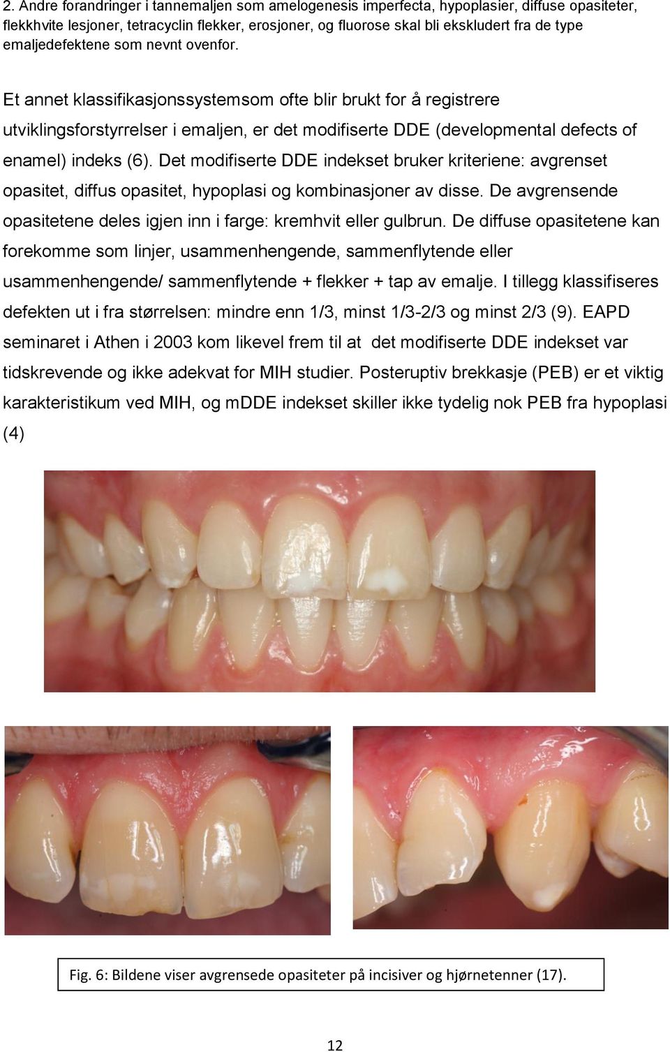 Et annet klassifikasjonssystemsom ofte blir brukt for å registrere utviklingsforstyrrelser i emaljen, er det modifiserte DDE (developmental defects of enamel) indeks (6).