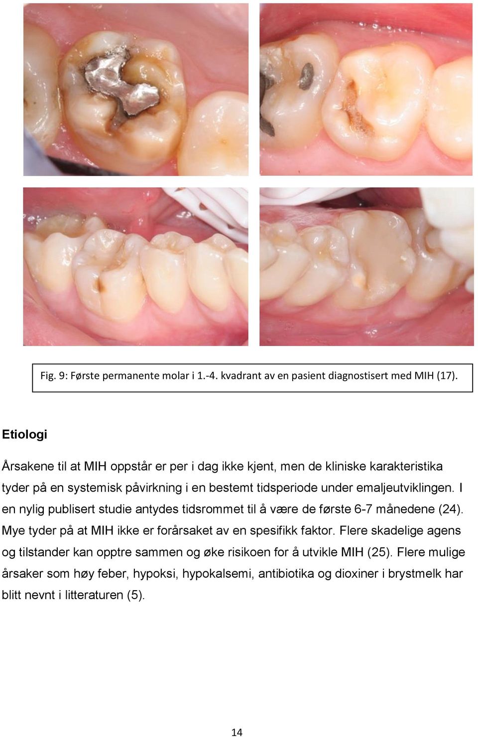 emaljeutviklingen. I en nylig publisert studie antydes tidsrommet til å være de første 6-7 månedene (24).