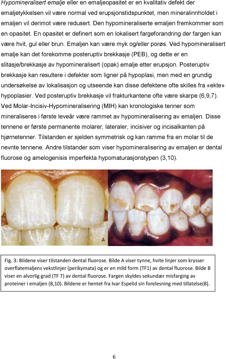 Ved hypomineralisert emalje kan det forekomme posteruptiv brekkasje (PEB), og dette er en slitasje/brekkasje av hypomineralisert (opak) emalje etter erupsjon.