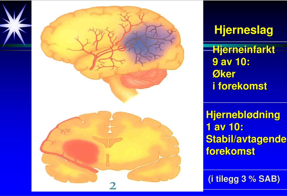 Hjerneblødning 1 av 10: