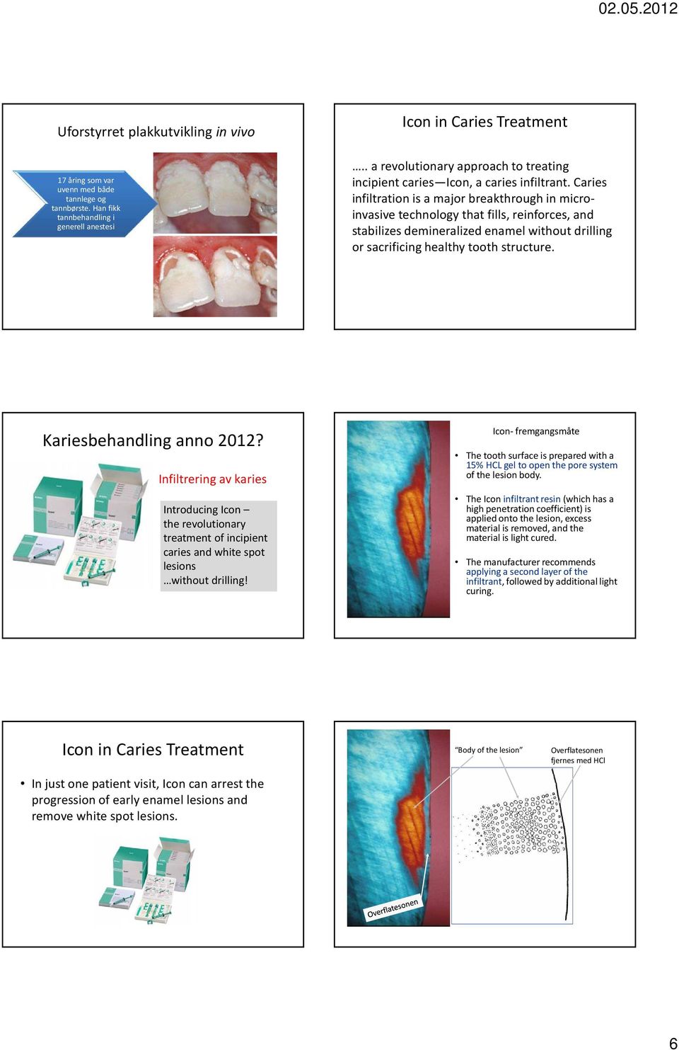 Caries infiltration is a major breakthrough in microinvasive technology that fills, reinforces, and stabilizes demineralized enamel without drilling or sacrificing healthy tooth structure.