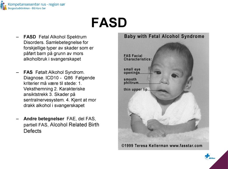 svangerskapet FASD FAS Føtalt Alkohol Syndrom. Diagnose. ICD10 - Q86 Følgende kriterier må være til stede: 1.