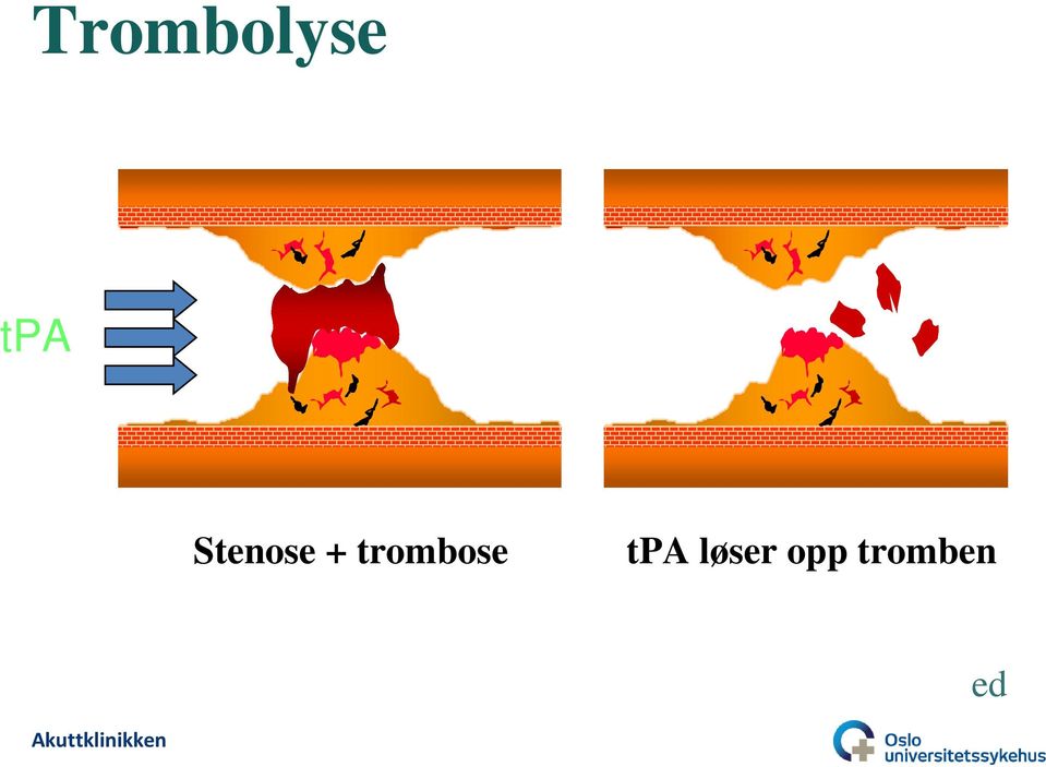 trombose tpa