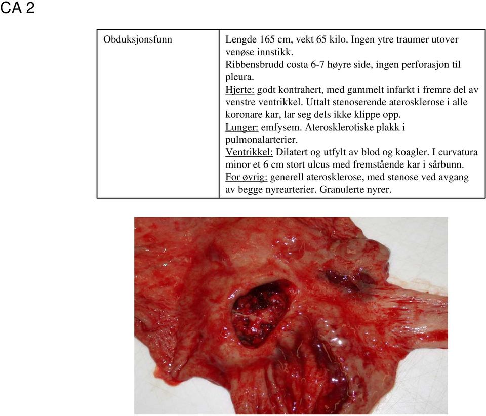 Uttalt stenoserende aterosklerose i alle koronare kar, lar seg dels ikke klippe opp. Lunger: emfysem. Aterosklerotiske plakk i pulmonalarterier.