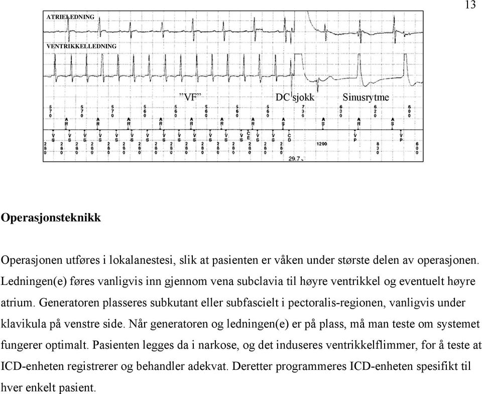 Generatoren plasseres subkutant eller subfascielt i pectoralis-regionen, vanligvis under klavikula på venstre side.