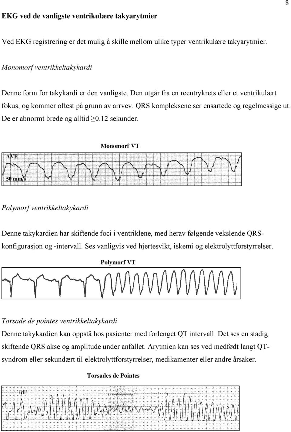 QRS kompleksene ser ensartede og regelmessige ut. De er abnormt brede og alltid 0.12 sekunder.