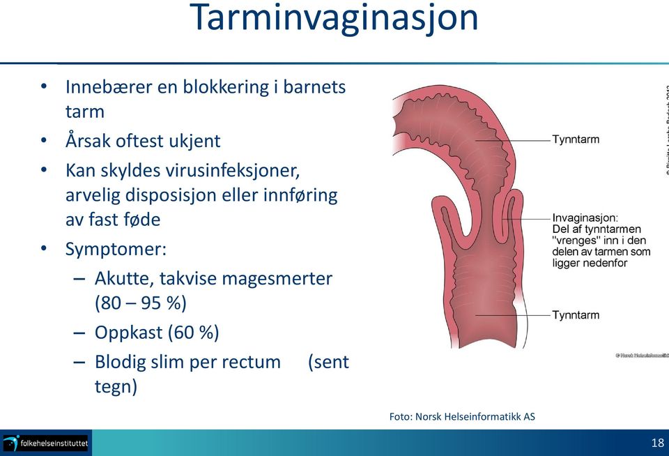 innføring av fast føde Symptomer: Akutte, takvise magesmerter (80 95 %)