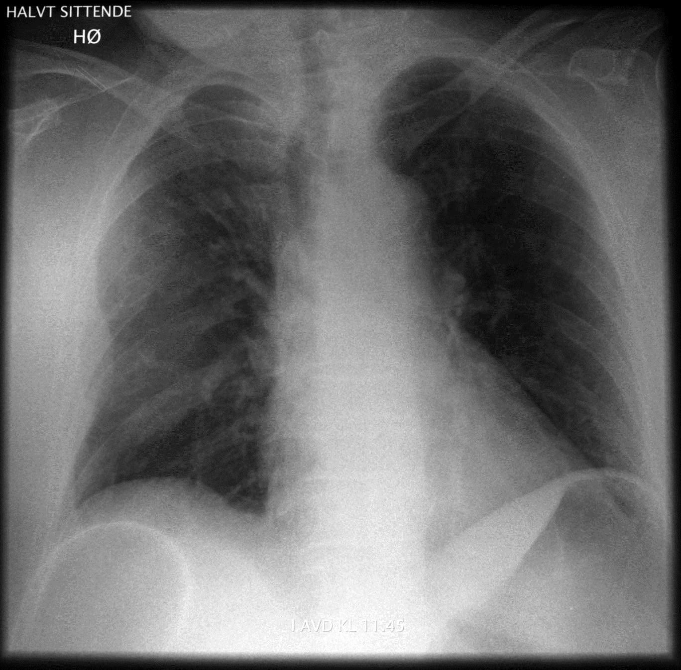 Extrapleural