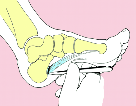 Indikasjoner operasjon Progredierende deformitet Smerter Kallositeter Ankel instabilitet Prinsipper ved kirurgi Fleksible cavusføtter: Seneforflytninger for å balansere foten Rigide cavusføtter: