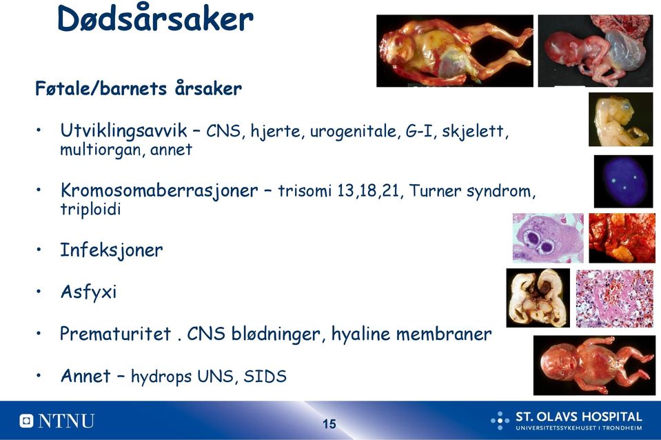 trisomi 13,18,21, Turner syndrom, triploidi Infeksjoner Asfyxi