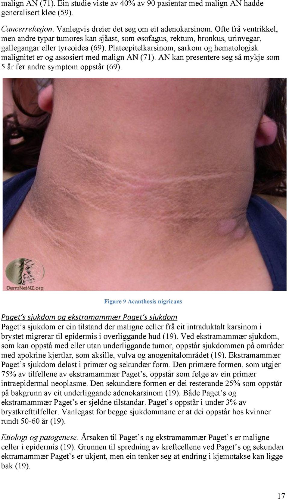 Plateepitelkarsinom, sarkom og hematologisk malignitet er og assosiert med malign AN (71). AN kan presentere seg så mykje som 5 år før andre symptom oppstår (69).