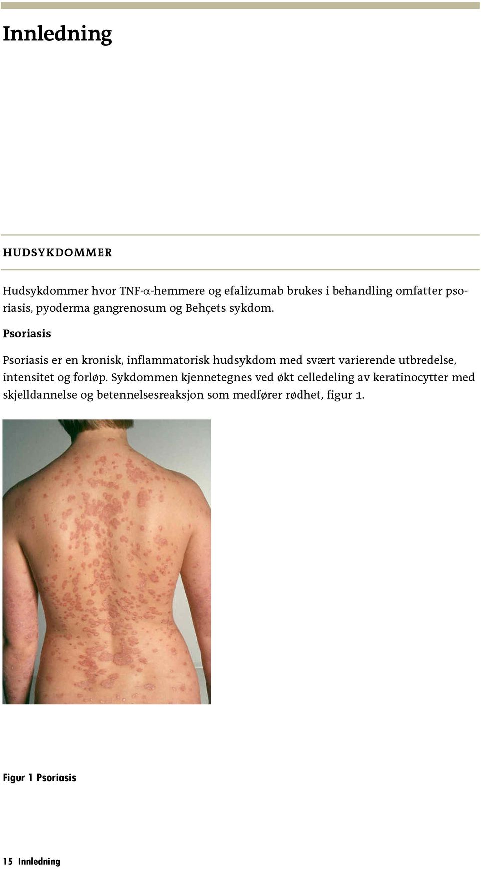 Psoriasis Psoriasis er en kronisk, inflammatorisk hudsykdom med svært varierende utbredelse, intensitet og