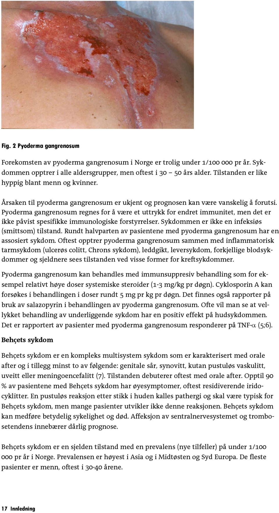 Pyoderma gangrenosum regnes for å være et uttrykk for endret immunitet, men det er ikke påvist spesifikke immunologiske forstyrrelser. Sykdommen er ikke en infeksiøs (smittsom) tilstand.