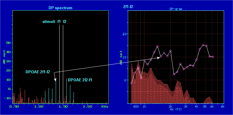 1425&1500Hz DPOAE Hear