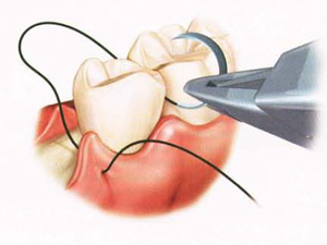 Forside Valg av suturmateriale ved oralkirurgiske inngrep - En spørreundersøkelse Prosjektoppgave for det integrerte masterstudiet i odontologi