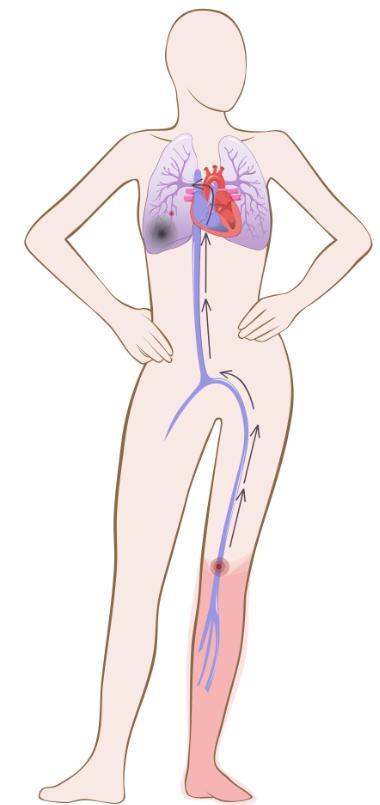 Venøs trombose blodig alvor Lungeemboli kan medføre alvorlig pustebesvær, brystsmerter, hjertesvikt og død. Vener er blodårer som fører blodet fra kroppens vev og organer tilbake til hjertet.