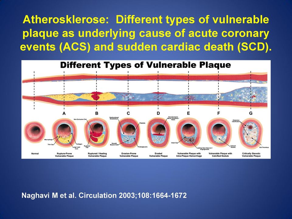events (ACS) and sudden cardiac death (SCD).