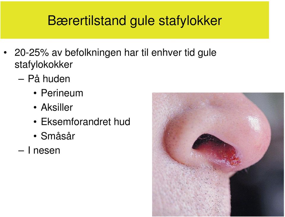 gule stafylokokker På huden Perineum