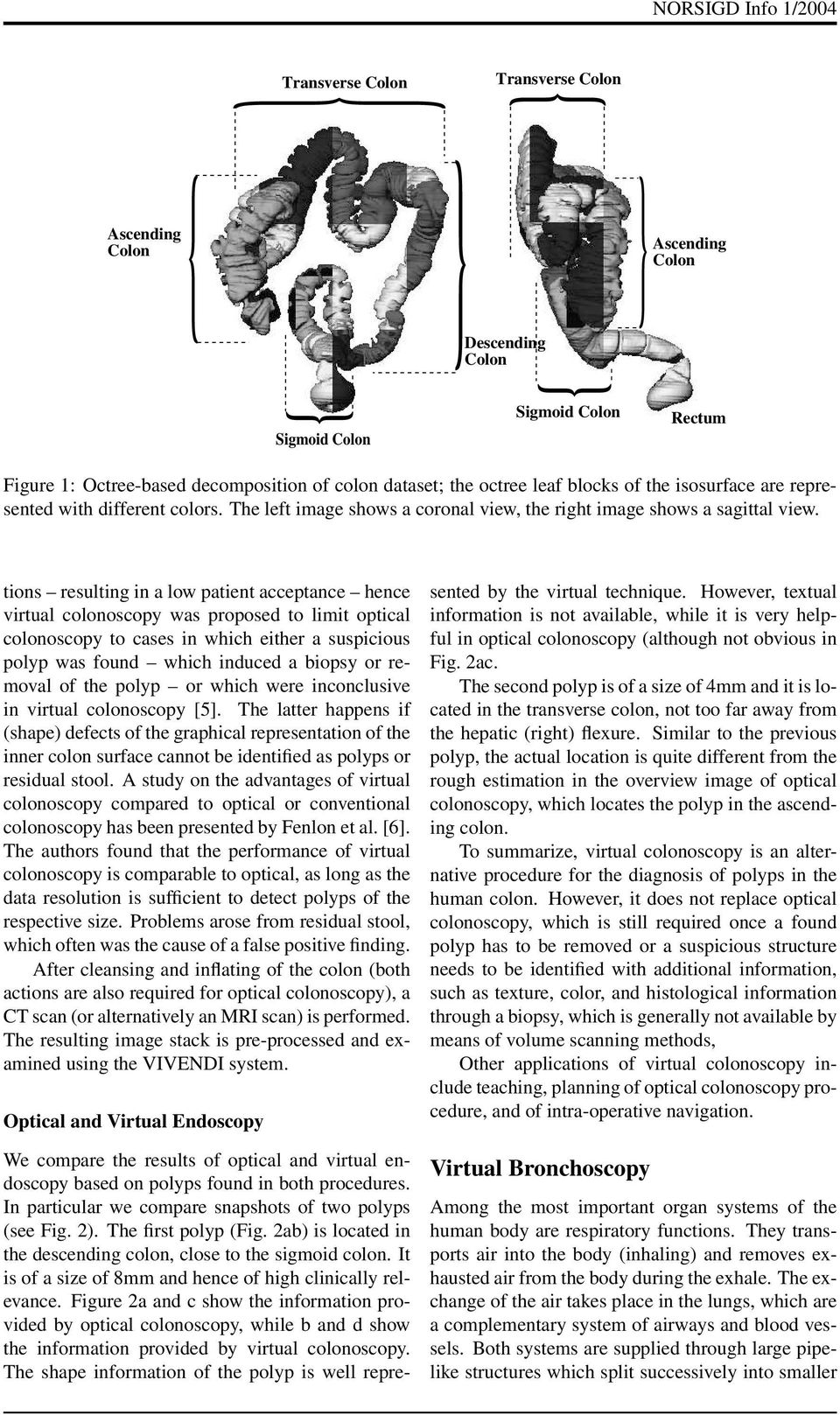 tions resulting in a low patient acceptance hence virtual colonoscopy was proposed to limit optical colonoscopy to cases in which either a suspicious polyp was found which induced a biopsy or removal