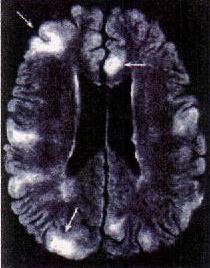 4 protein tuberin 16p13- protein hamarin Mental retardasjon 50% Autisme 25% Epilepsi