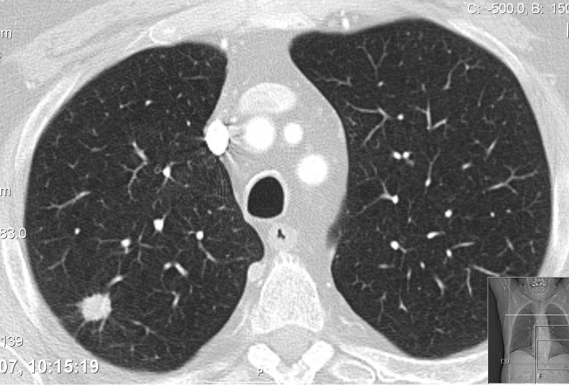 Små lungelesjoner SPN Solitære pulmonale noduli Diagnostisering og