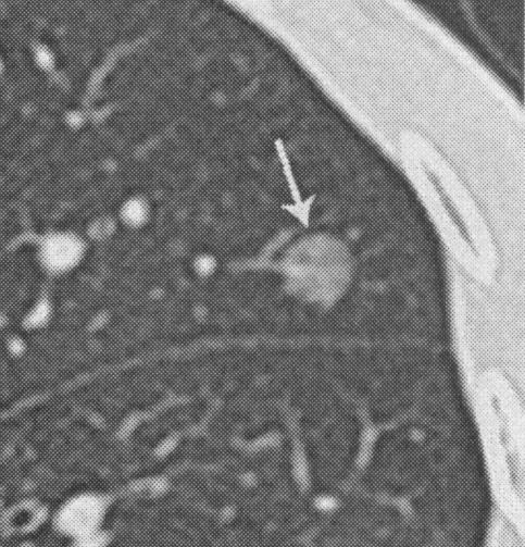 2 runde mattglassfortetninger Bronchioalveolærelle-carcinom Ikke-invasivt