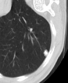 c3. Forkalkninger Diffus, tett forkalkning av nodulus Svært karakteristisk for eldre granulomatøs lesjon.