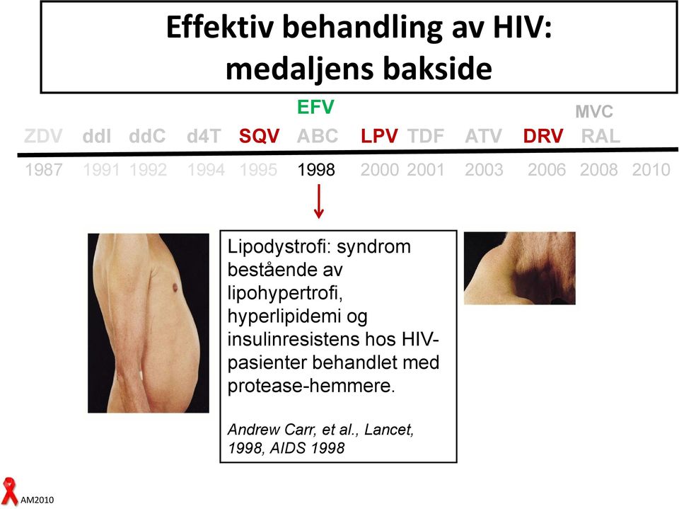 syndrom bestående av lipohypertrofi, hyperlipidemi og insulinresistens hos