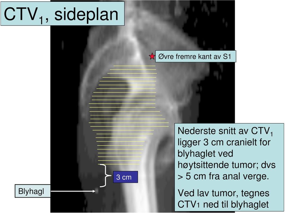 blyhaglet ved høytsittende tumor; dvs > 5 cm fra