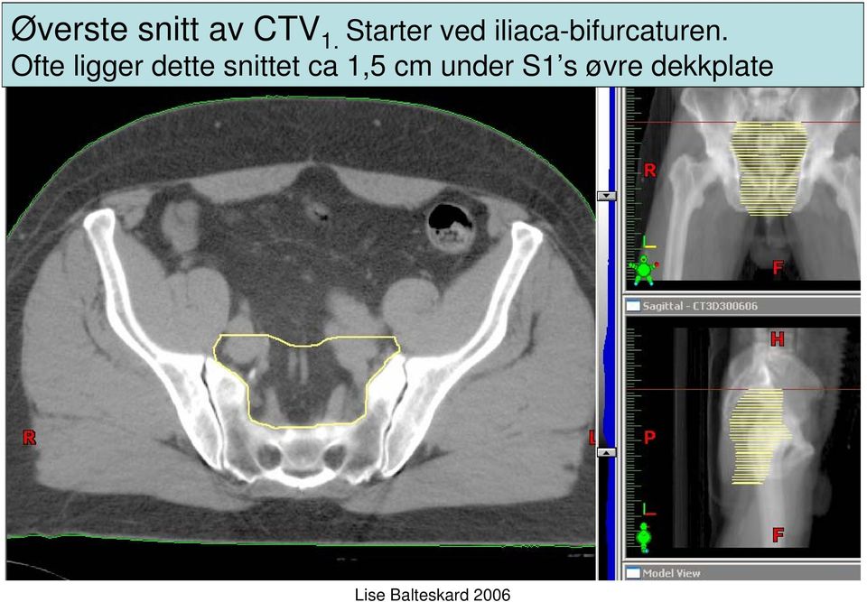 iliaca-bifurcaturen.