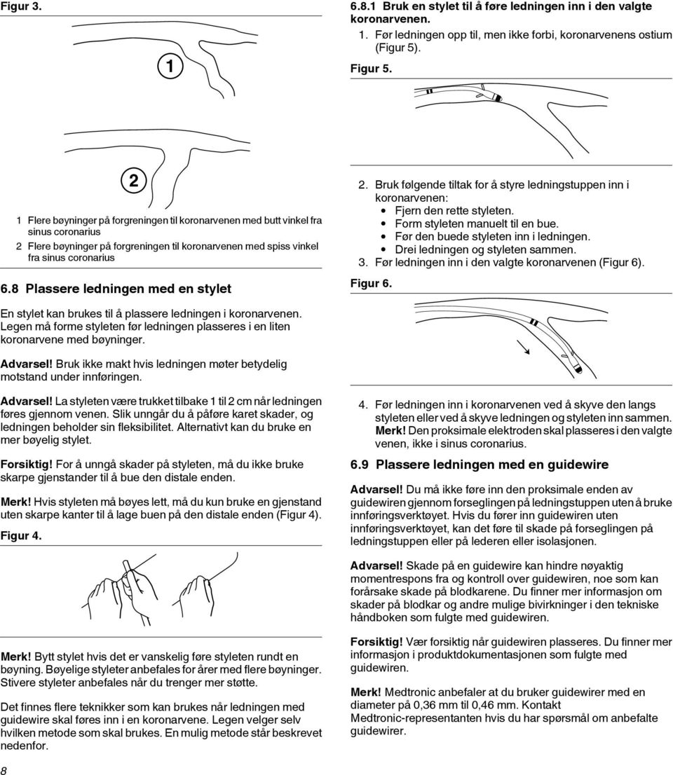 8 Plassere ledningen med en stylet 2. Bruk følgende tiltak for å styre ledningstuppen inn i koronarvenen: Fjern den rette styleten. Form styleten manuelt til en bue.