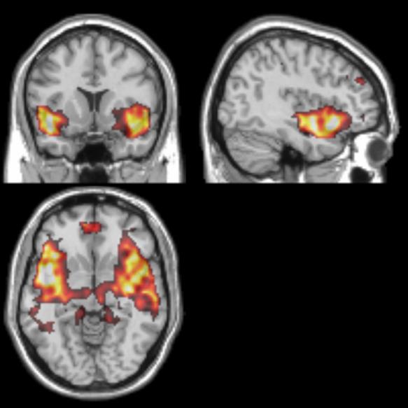 PERCEPTUAL (AUDITORY) NETWORK Area specificity Kognitiv dimensjon, redusert connectivity mellom frontale og temporale områder Altered inter-connectivity between perceptual and cognitive networks 0,65