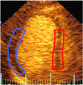 Ultralyd kontrast bedrer endokardavgrensningen slik at vurdering av regionalfunksjon ved stressekkokardiografi blir lettere og gir samtidig informasjon om regional myokardperfusjon som bidrar til å
