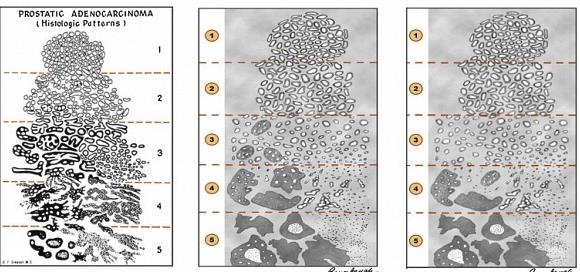 ISUP Modifisert Gleason score ISUP: International Society of Urological Pathology 2005/2015 (Epstein et al Am J Surg Pathol 2005;