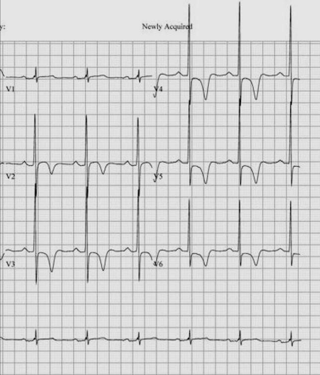 Athlete HCM ECG EKG mønstre er ikke veldig gode for