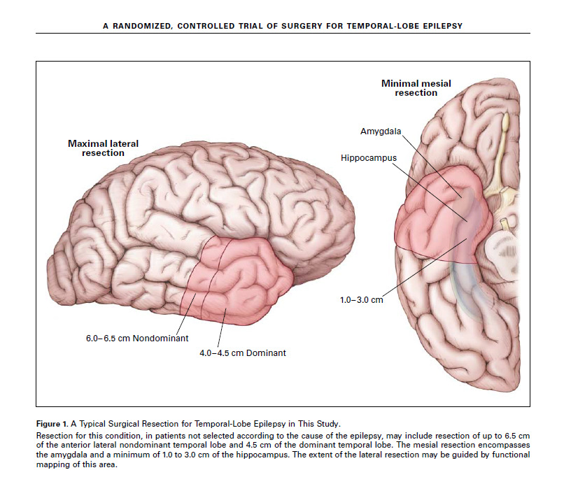 Utredning for epilepsikirurgi Anamnese Motorikk EEG Språk Telemetri PET MR Klinisk anfallsutforming Epilepsidebut Anfallsstart, nøyaktig anfallsutforming og anfallssituasjon Epilepsiens påvirkning