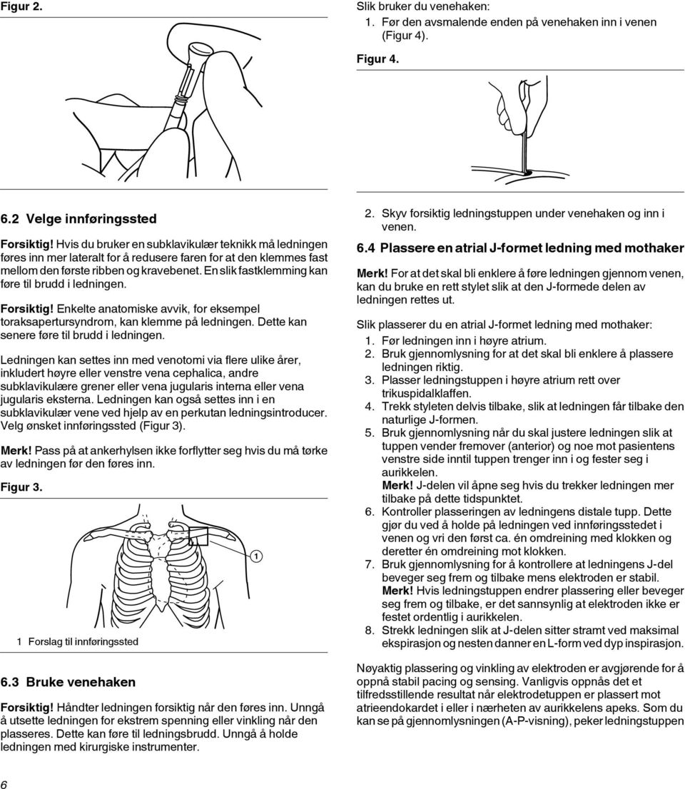 En slik fastklemming kan føre til brudd i ledningen. Forsiktig! Enkelte anatomiske avvik, for eksempel toraksapertursyndrom, kan klemme på ledningen. Dette kan senere føre til brudd i ledningen.