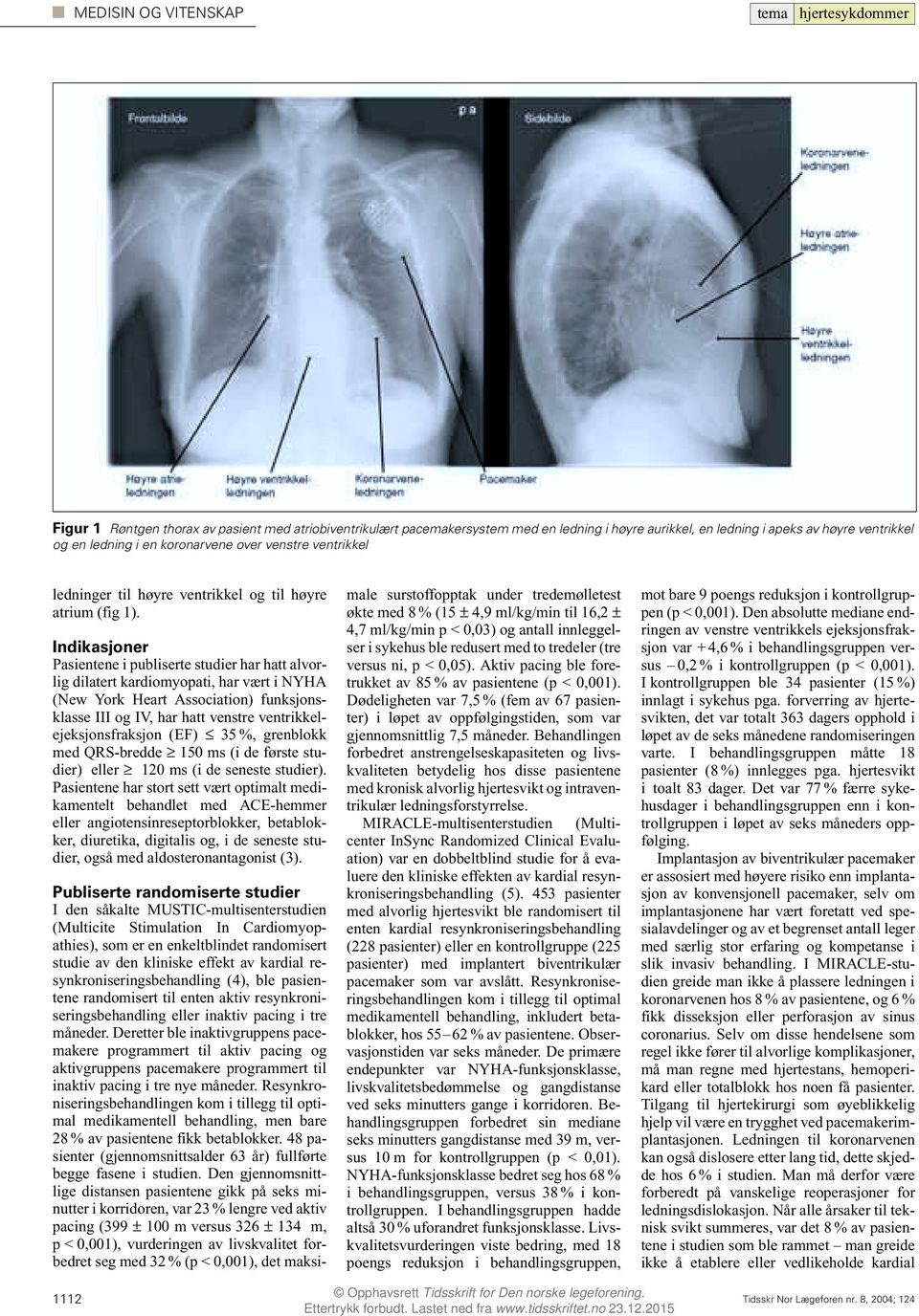 Indikasjoner Pasientene i publiserte studier har hatt alvorlig dilatert kardiomyopati, har vært i NYHA (New York Heart Association) funksjonsklasse III og IV, har hatt venstre